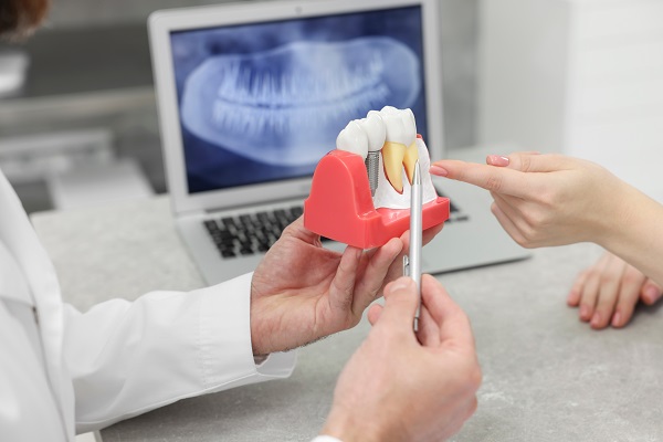 What Happens After Dental Implants Are Placed?