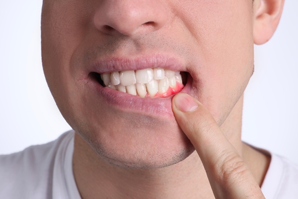 Gum Disease: What You Should Know