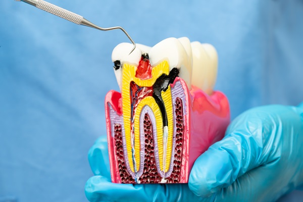 How To Care For A Root Canal Tooth