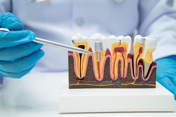 When Dental Pain May Indicate The Need For A Root Canal
